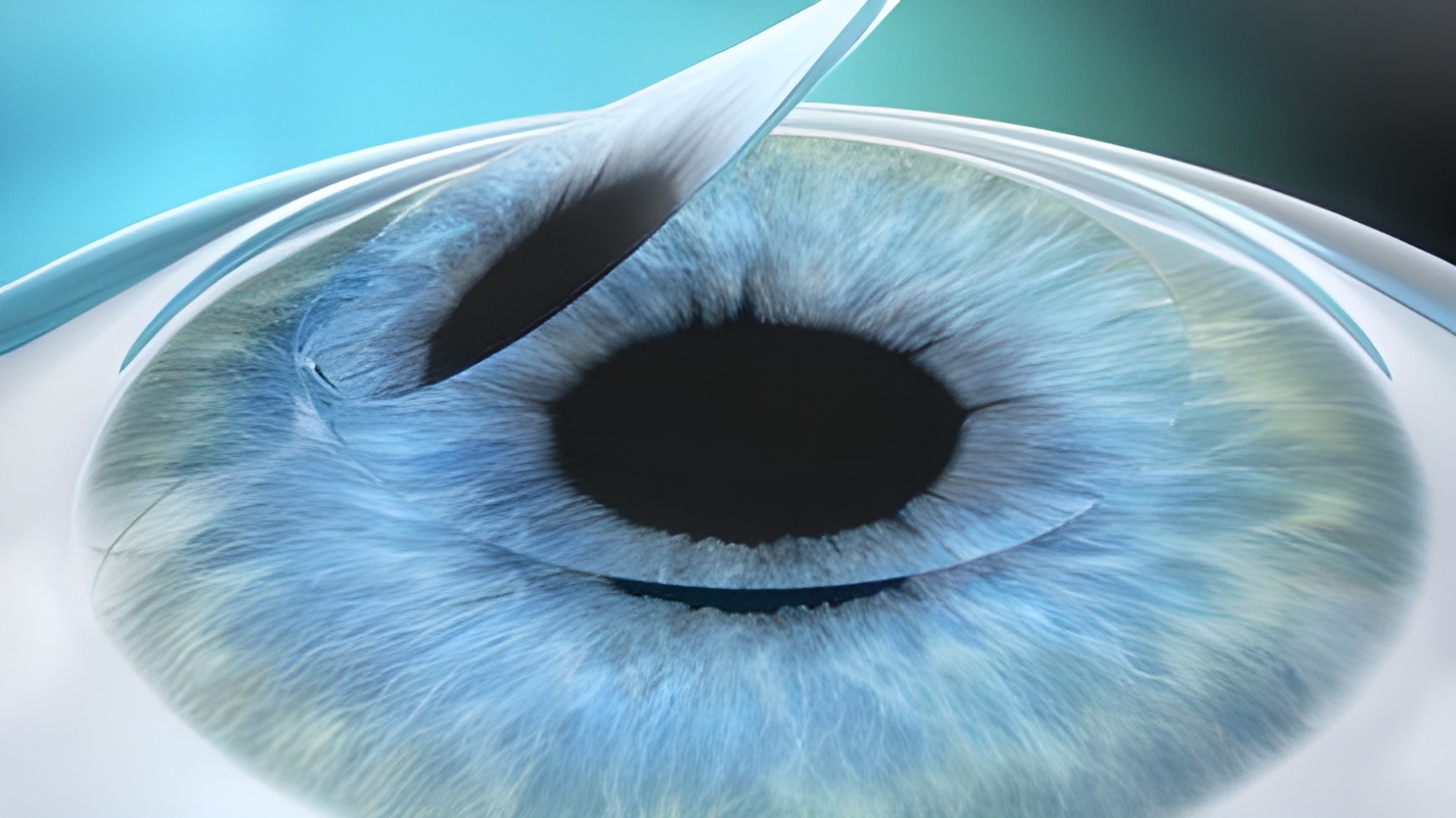 Схематическое изображение глаза во время операции Lasik