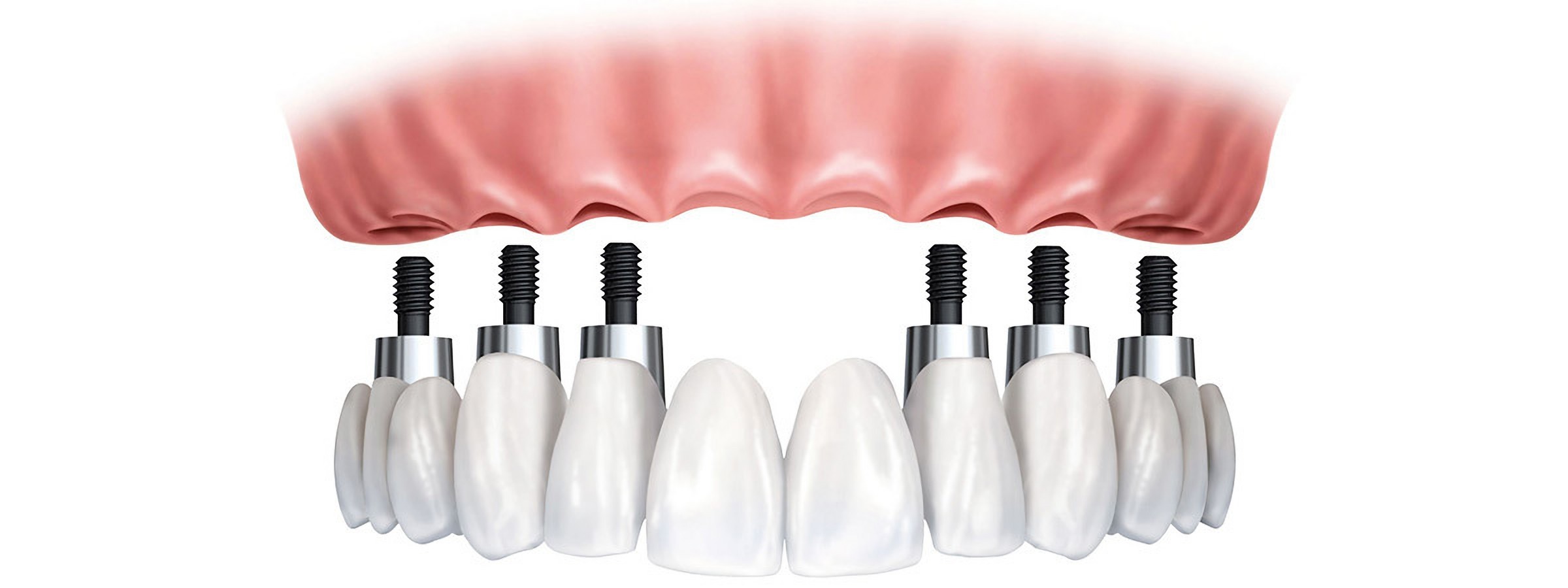 Установка зубных имплантов в Турции