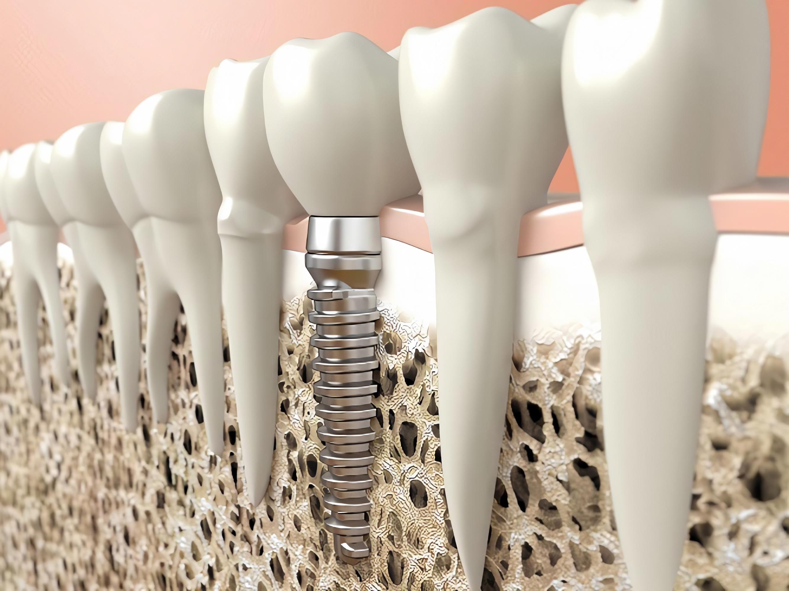 Остеопороз и зубные имплантаты