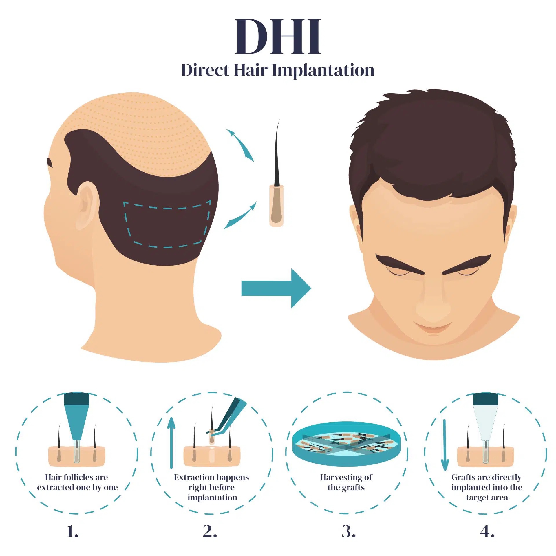 Трансплантация волос DHI в Турции