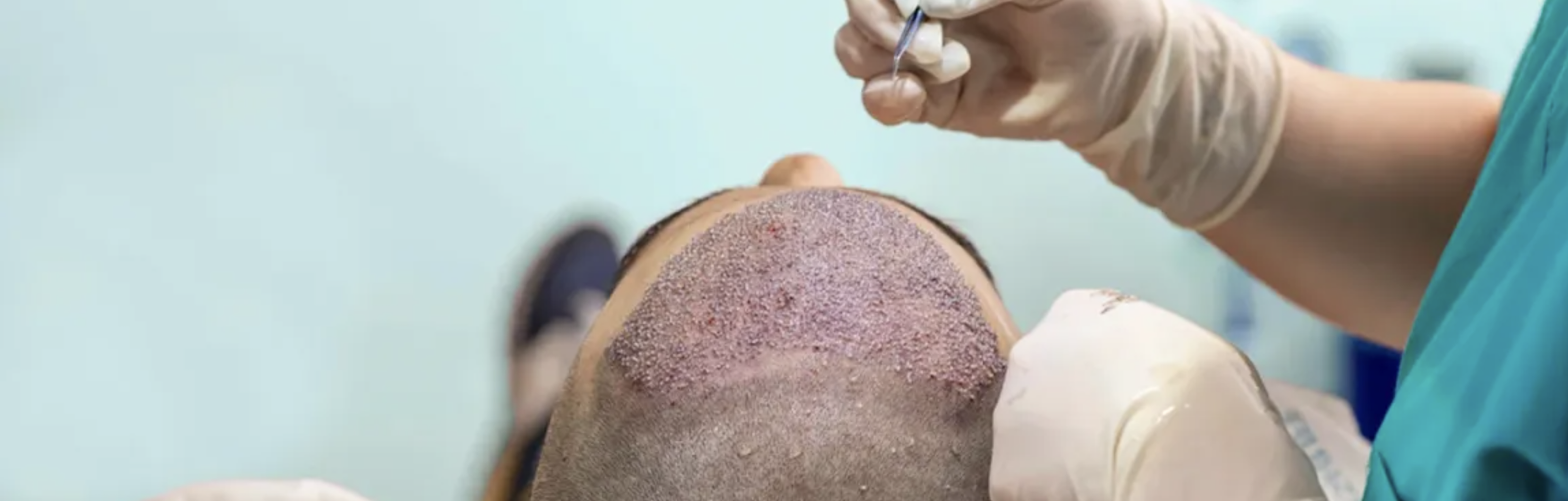 FUE метод пересадки волос в Турции