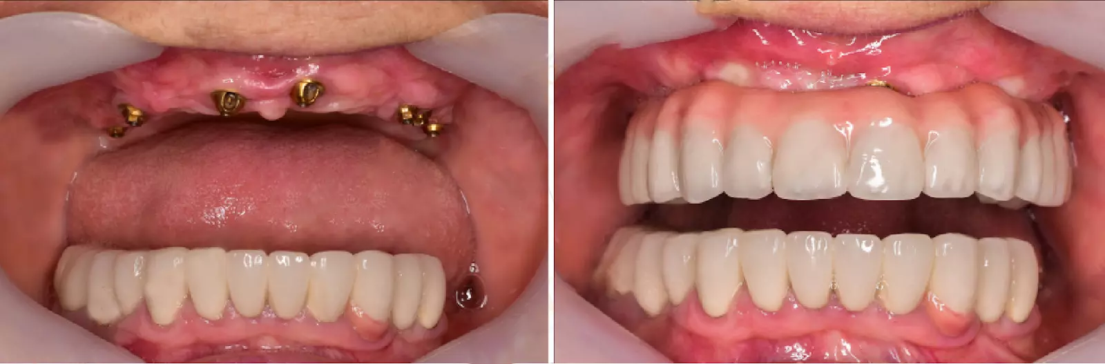 Имплантация зубов All on 6 в Турции