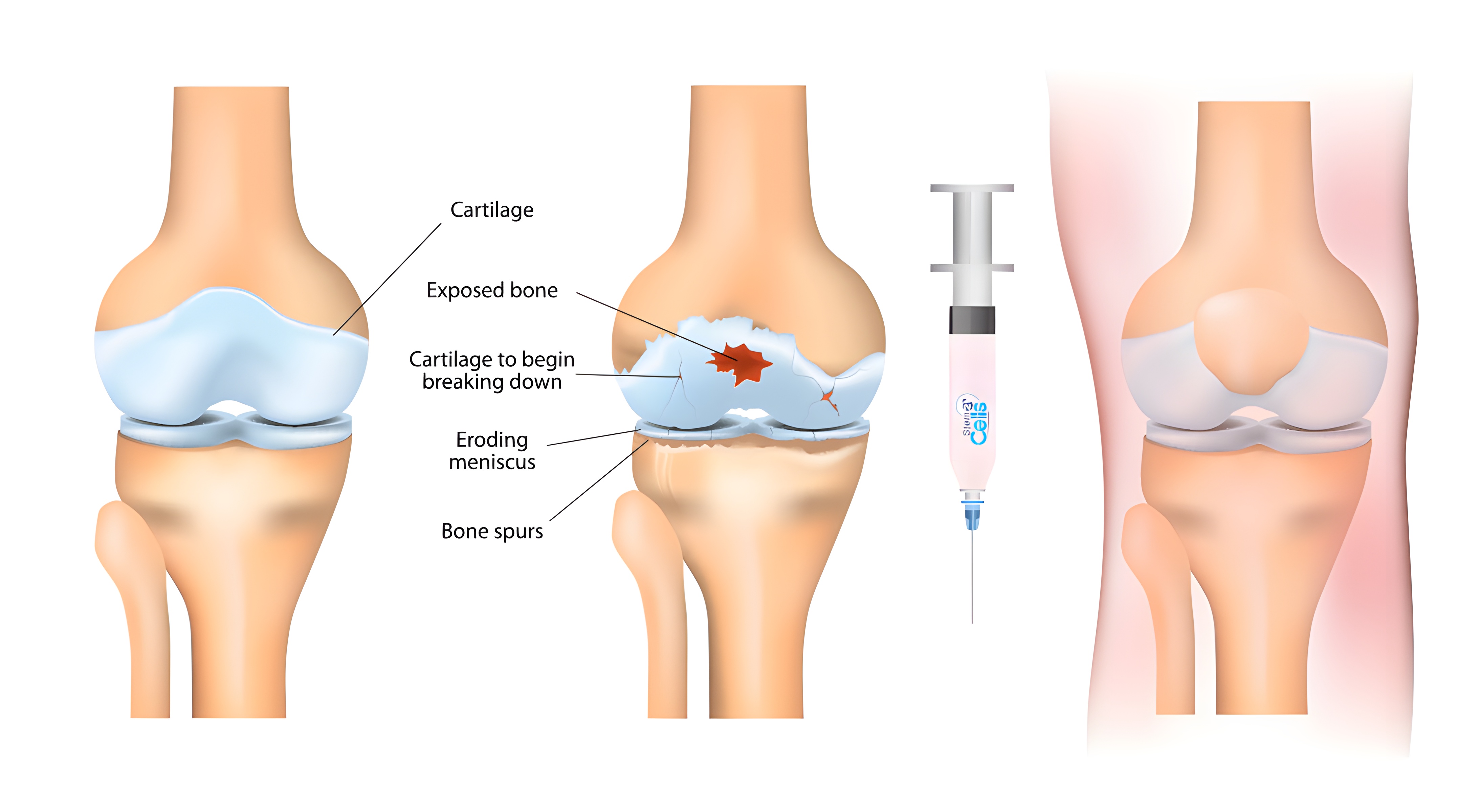 Инъекция мезенхимальных стволовых клеток в коленный сустав при остеоартрите