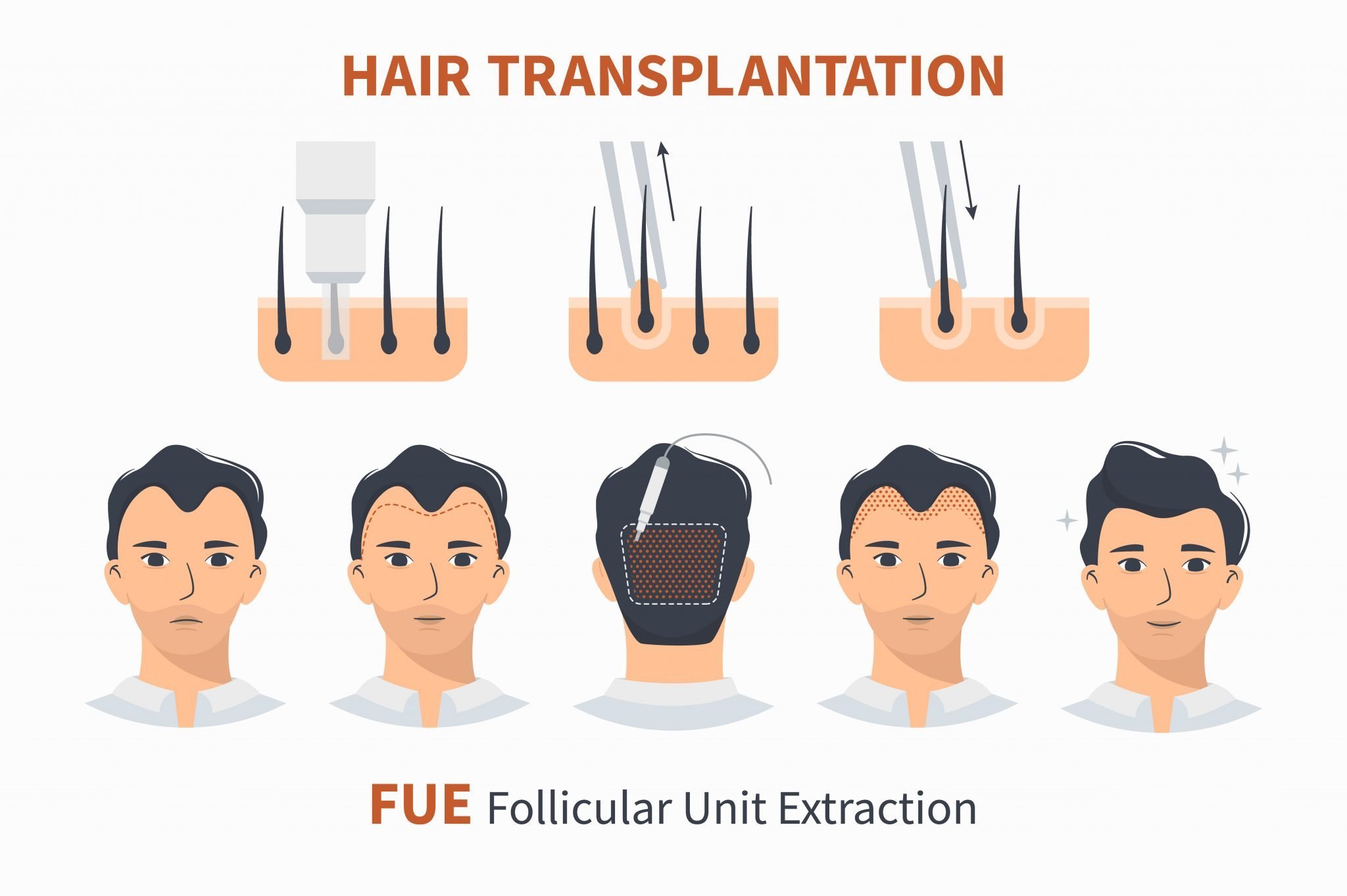 FUE метод Трансплантации волос