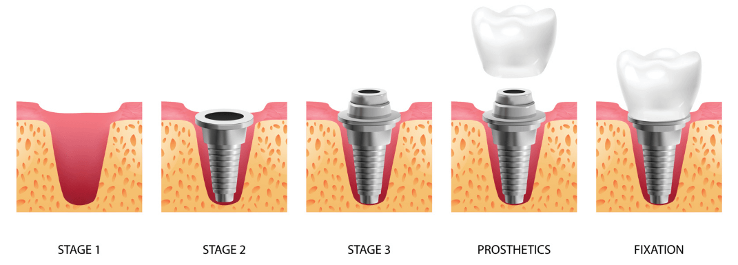 Этапы установки зубного импланта во Львове