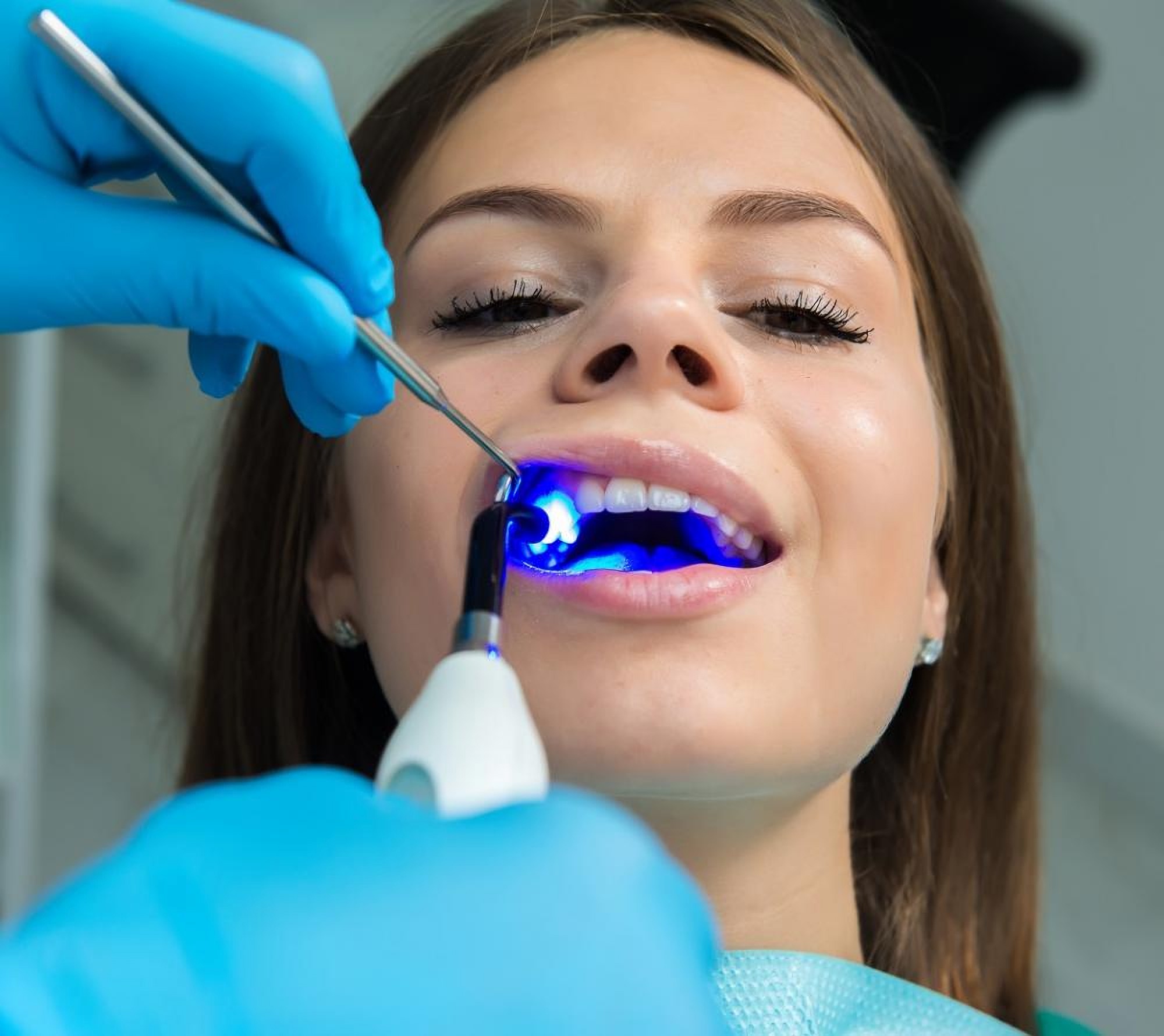 Пломбирование зубов в стоматологической клинике Granddent в Одессе Украина