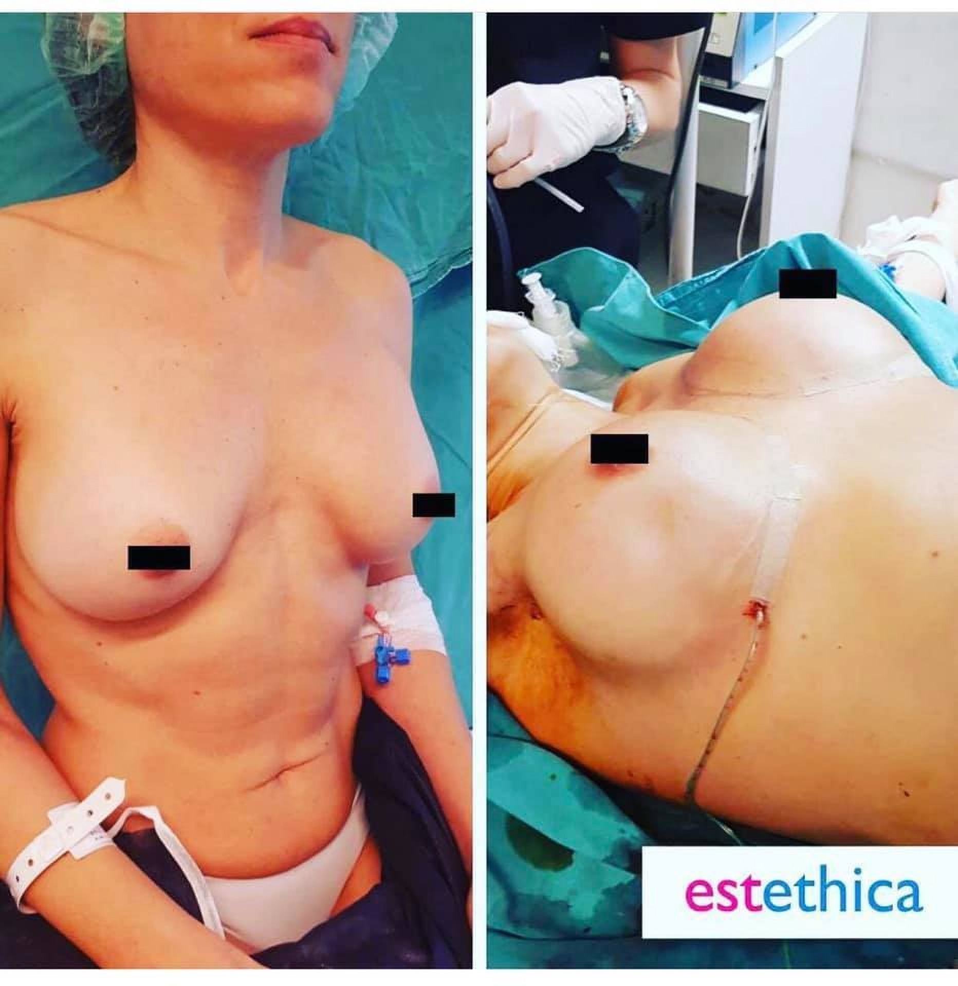 Увеличение груди в Стамбуле в клинике Estethica