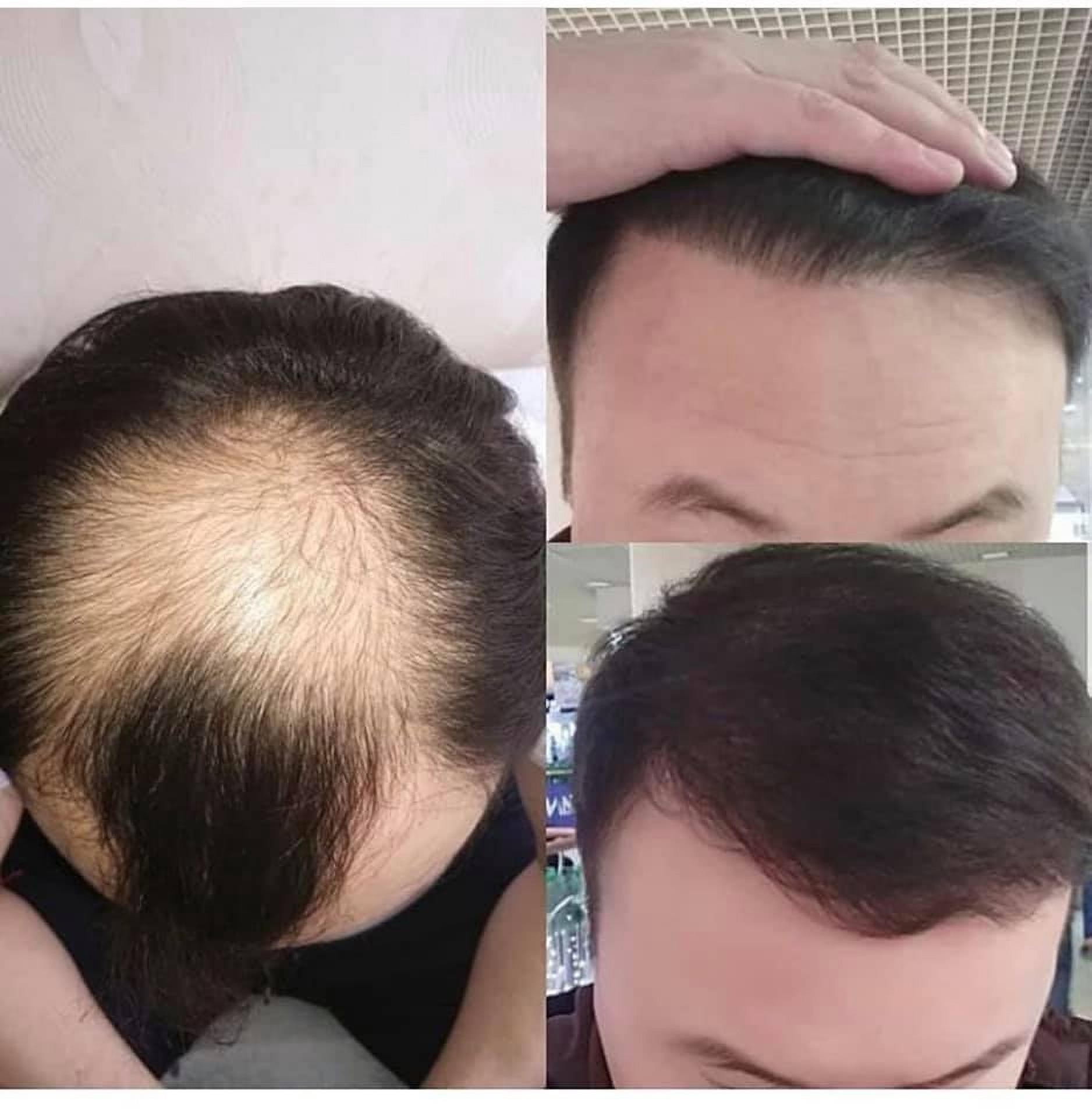 Пересадка волос до и после в Стамбуле в клинике Estethica