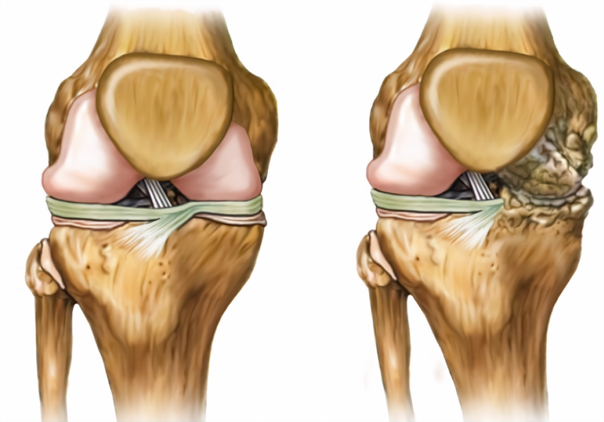 Терапия мезенхимальными стволовыми клетками при остеоартрите коленного сустава