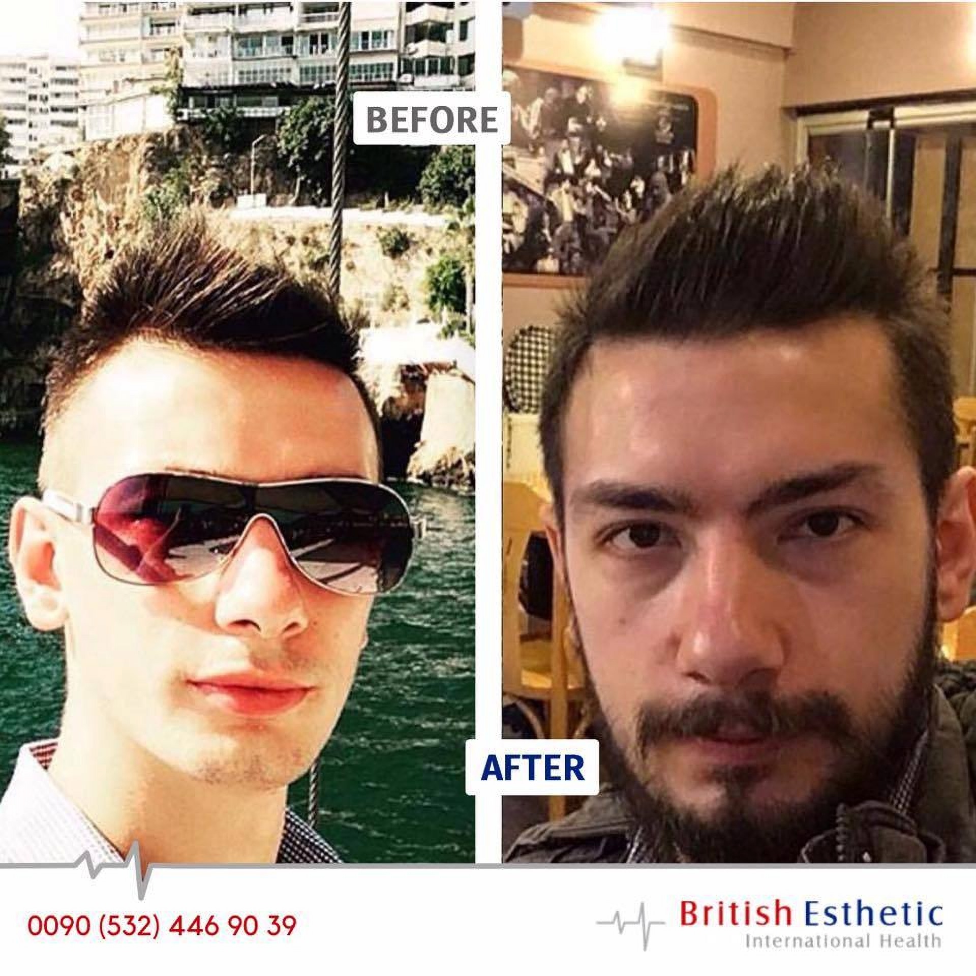 Пересадка волос и бороды в клинике British Estetik в Стамбуле